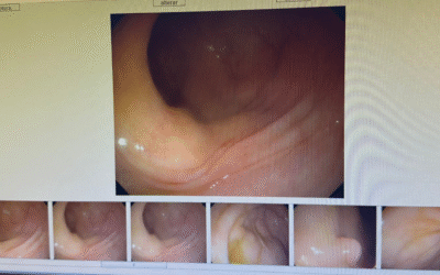 Colonoscopia salva vidas: porque fazer, quando fazer e como a ENOVA cuida de você.