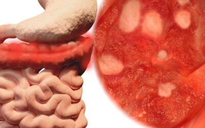 Maio Roxo: O que são as Doenças Inflamatórias Intestinais?